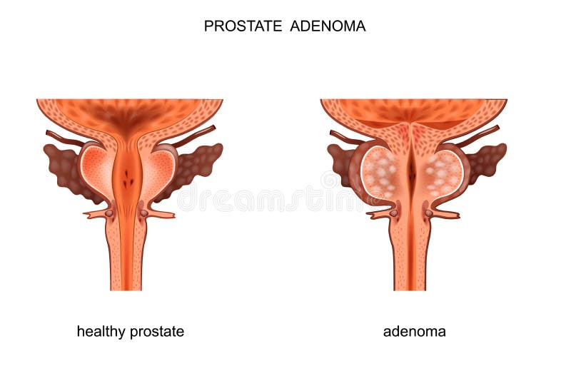 Próstata sana y BPH
