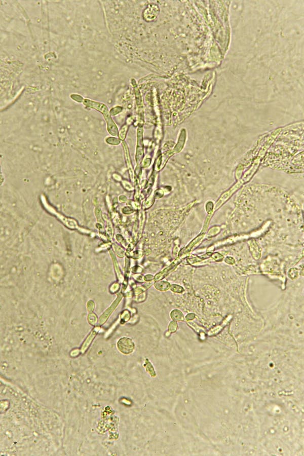Дрожжевые клетки в моче повышены. Дрожжевые клетки в моче. Cell в моче. Дрожжевые нити в моче. Фото дрожжеподобный грибок в моче.