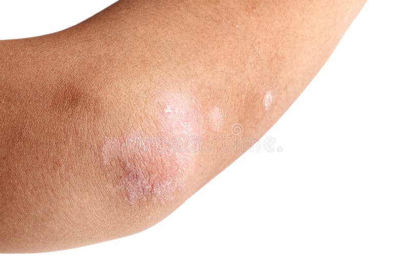 Psoriasis On Elbow Skin Stock Image Image Of Disorder 40723075