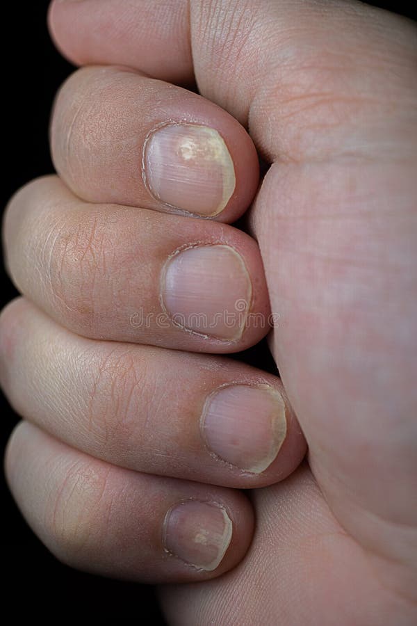 Nail bed psoriasis of fingernails. | Download Scientific Diagram