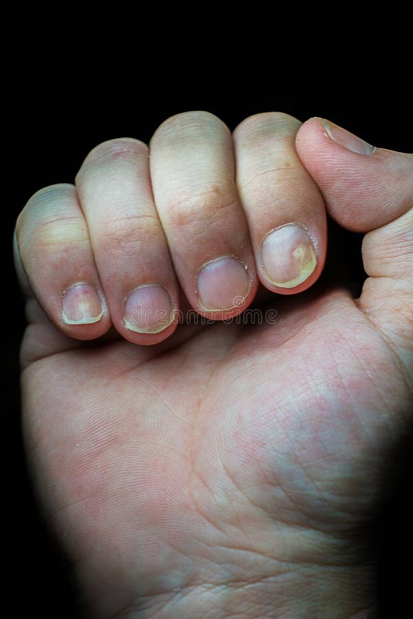 Closeup of the Fingers of a Patient with Psoriatic Onychodystrophy or Psoriatic  Nails Disease Stock Photo - Image of psoriatic, skin: 261086214