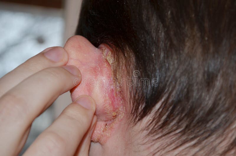 Psoriasis Behind the Ear, Pushes the Ear, Dermatological Problems, Skin