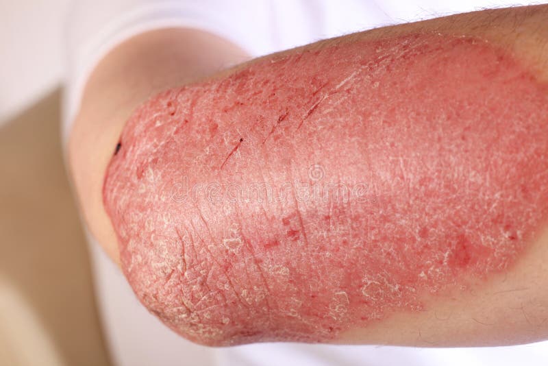 Psoriasis de plaque photo stock. Image du surface, inflammation 33761352