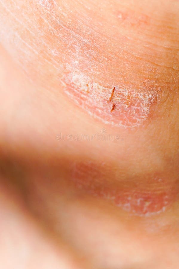 Psoriasis Dry Red And White Irritation On The Skin Closeup Stock Image