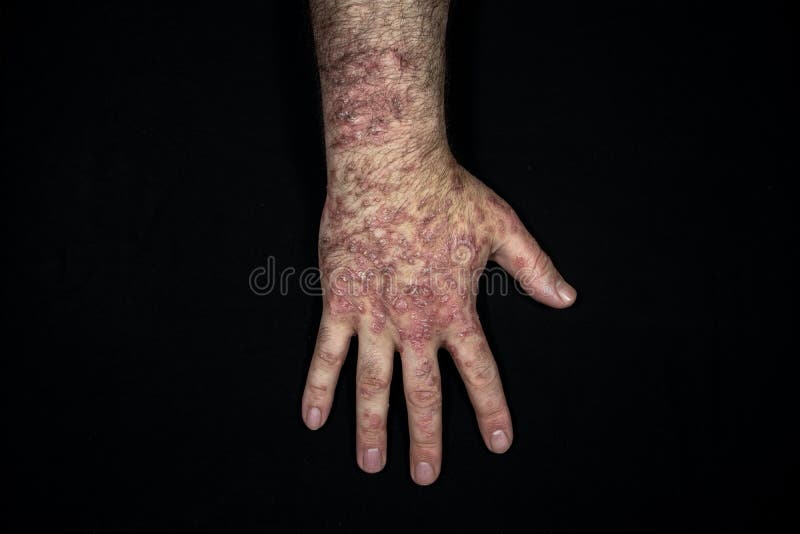 Psoriasis Eczema On The Hand Isolated On Black Background Stock Photo