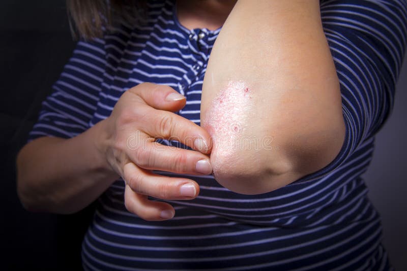 Psoriasis on elbow royalty free stock image