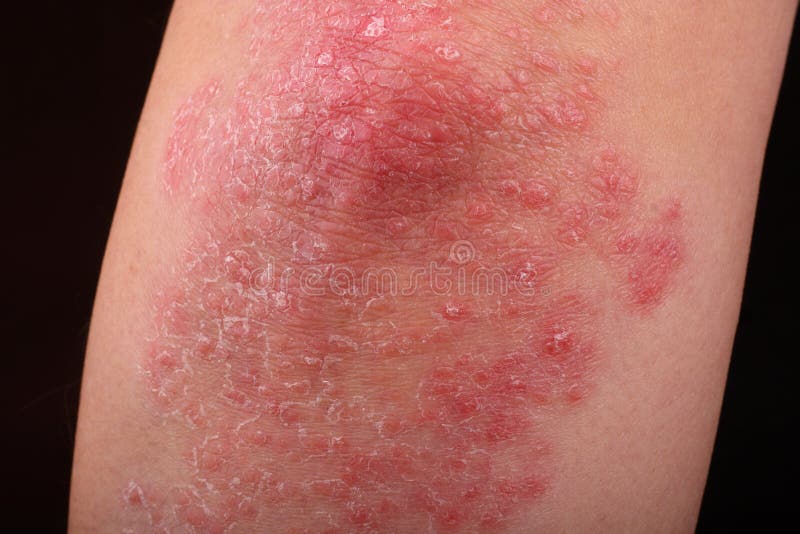 Psoriasis