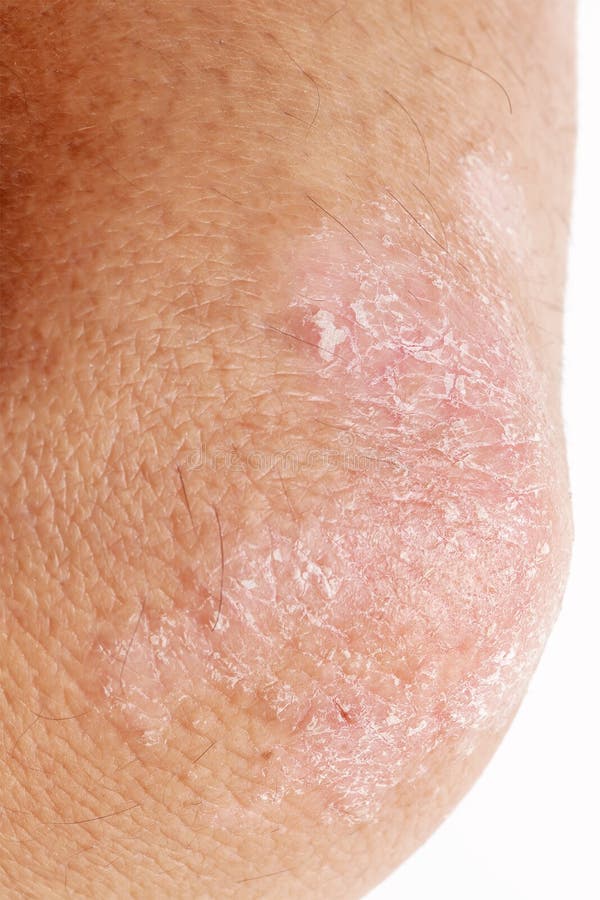 Psoriasis On Elbow Isolated Closeup Of Rash And Scaling On The