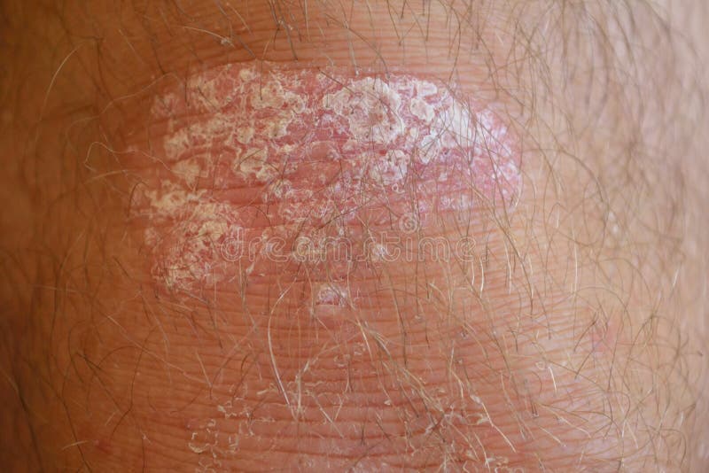 Psoriasis on the knee stock image. Image of dermatopathy 71907931