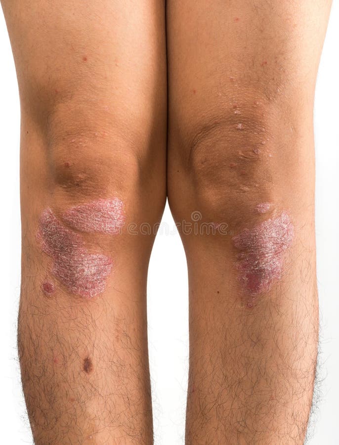 Psoriasis on the Knee Shows Redness and Applying and Dry Flaky S Stock