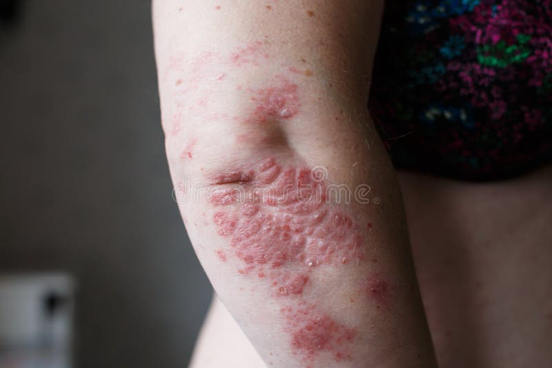 Psoriasis Skin Psoriasis Is An Autoimmune Disease That Affects The