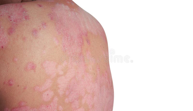 Psoriasis Is A Skin Disease Stock Image Image Of Infection Itchy