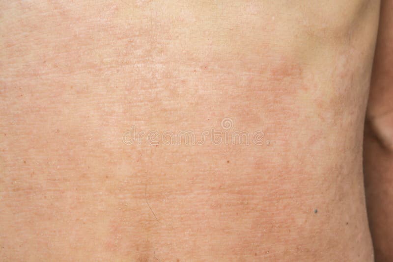 Psoriasis On The Skin Diseases And Conditions Stock Image Image Of