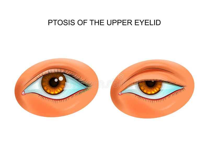 Ptosis des Augenlides vektor abbildung Ptosis des Augenlides vektor abbildung