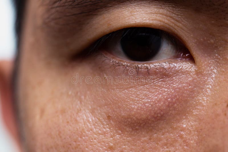 Ptosis Droopy eyelid in asian male oily skin type with dark eye bag royalty free stock photography Ptosis Droopy eyelid in asian male oily skin type with dark eye bag royalty free stock photography