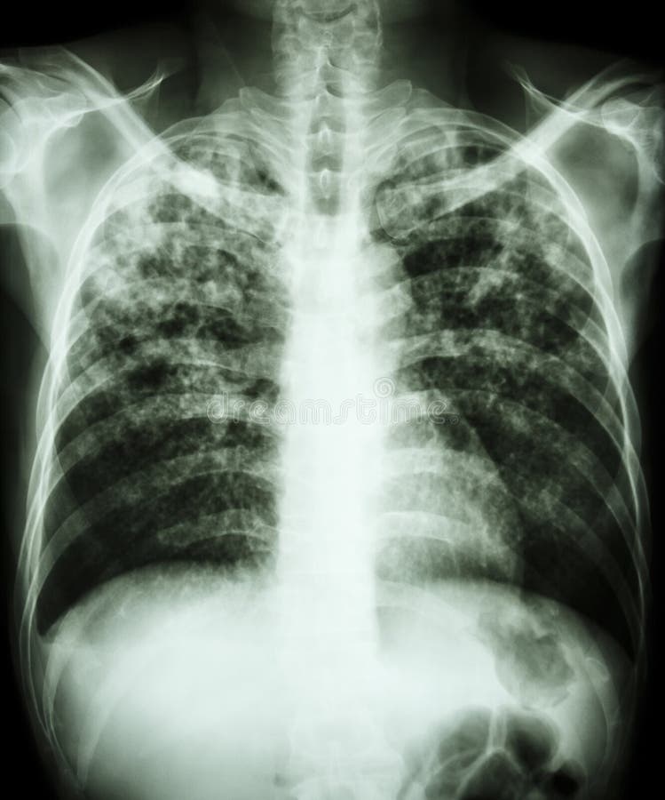 Pulmonary tuberculosis royalty free stock photo Pulmonary tuberculosis royalty free stock photo