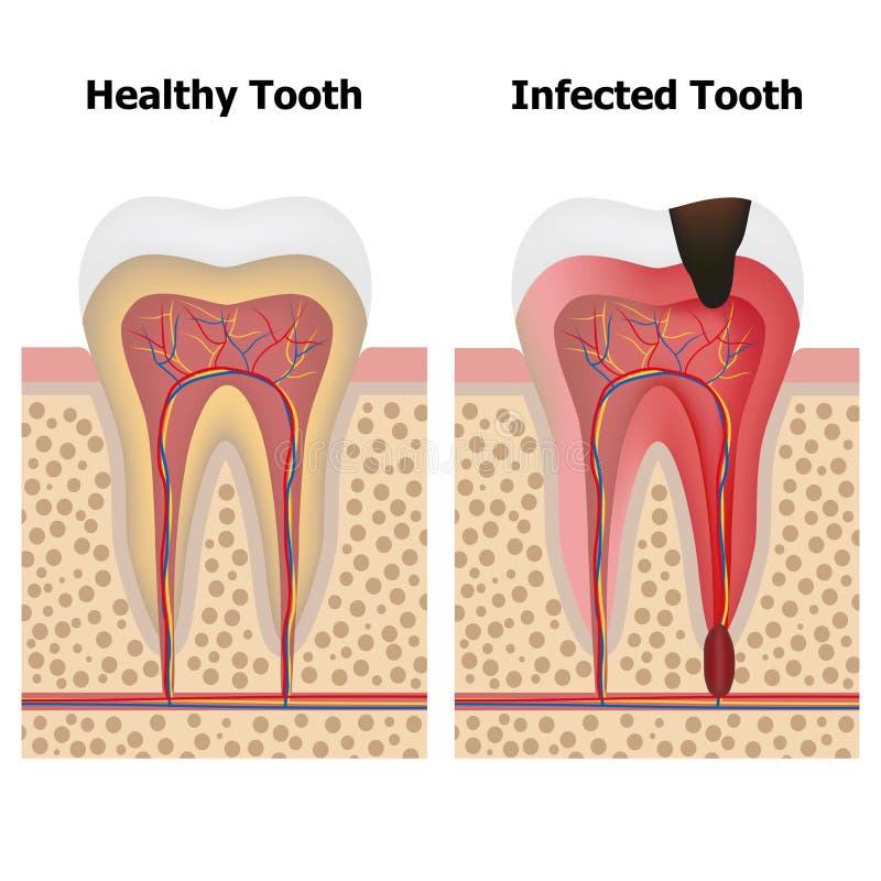 Pulpitis en Gezonde tand vector illustratie Pulpitis en Gezonde tand vector illustratie