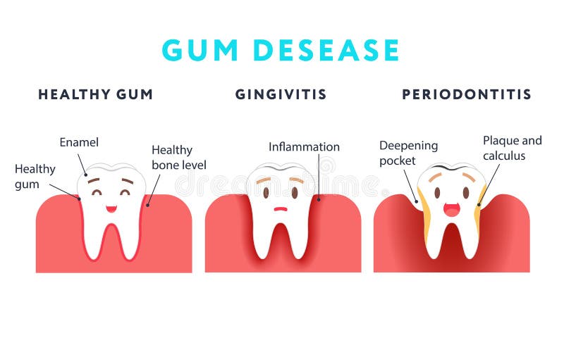 Punto della malattia di gomma Dente e gengivite sani illustrazione di stock Punto della malattia di gomma Dente e gengivite sani illustrazione di stock