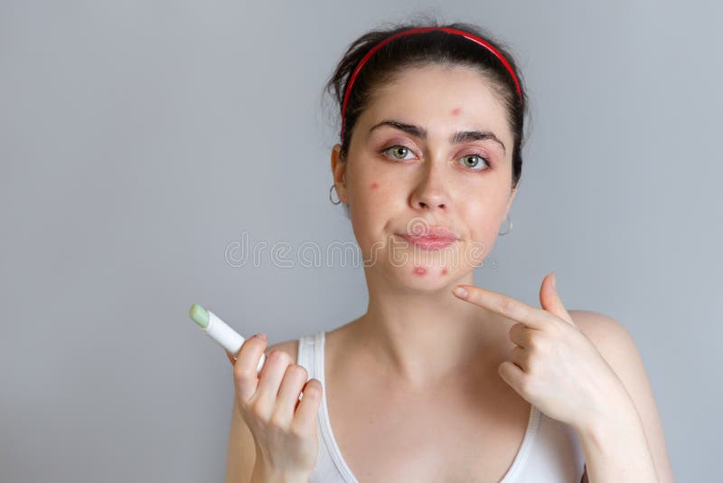 Puntos contrariedades de una mujer joven al acné en su barbilla El concepto de acné, creciendo y de cosmetología Copie el espacio