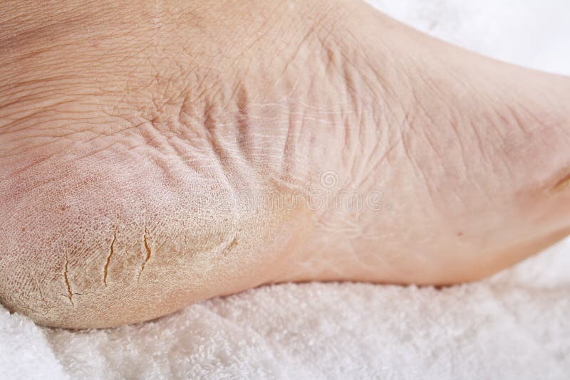 Pés que precisa um pedicure imagens de stock Pés que precisa um pedicure imagens de stock
