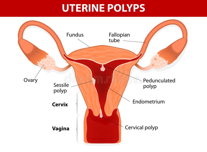 Pólipo endometrial o pólipo uterino