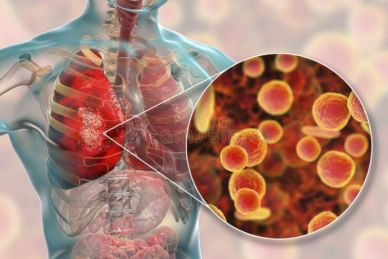 Płuco infekcja powodować bakterii Mycoplasma pneumoniae royalty ilustracja Płuco infekcja powodować bakterii Mycoplasma pneumoniae royalty ilustracja