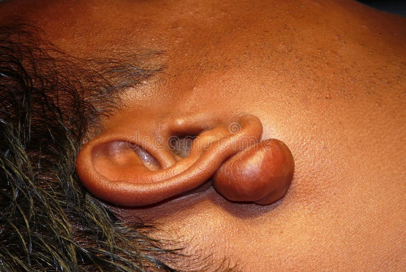 Keloids are the result of an overgrowth of dense fibrous tissue that usually develops after healing of a skin injury. The tissue extends beyond the borders of the original wound, does not usually regress spontaneously, and tends to recur after excision. These are very common at the site of ear lobe piercing. A keloid scar is benign, non-contagious, and sometimes accompanied by severe itchiness and pain. Keloids are the result of an overgrowth of dense fibrous tissue that usually develops after healing of a skin injury. The tissue extends beyond the borders of the original wound, does not usually regress spontaneously, and tends to recur after excision. These are very common at the site of ear lobe piercing. A keloid scar is benign, non-contagious, and sometimes accompanied by severe itchiness and pain.