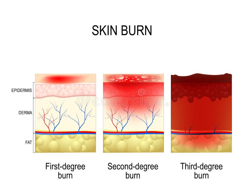 Skin burn. Three degrees of burns. type of injury to skin. step of burn. Skin burn. Three degrees of burns. type of injury to skin. step of burn