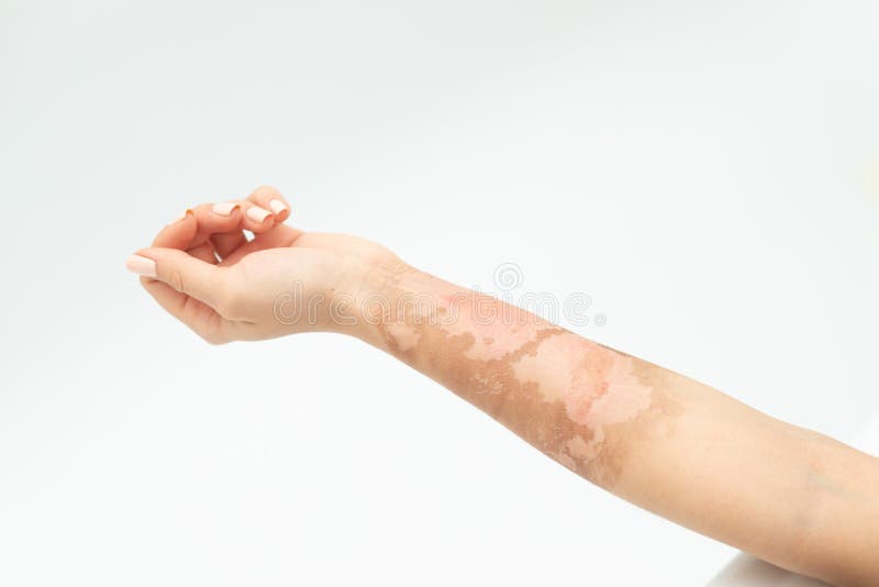 Quemadura de piel en una mano hembra sobre un fondo blanco