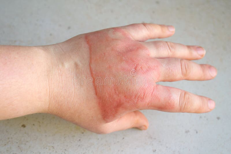Quemaduras de segundo grado horribles en la mano femenina en el fondo blanco