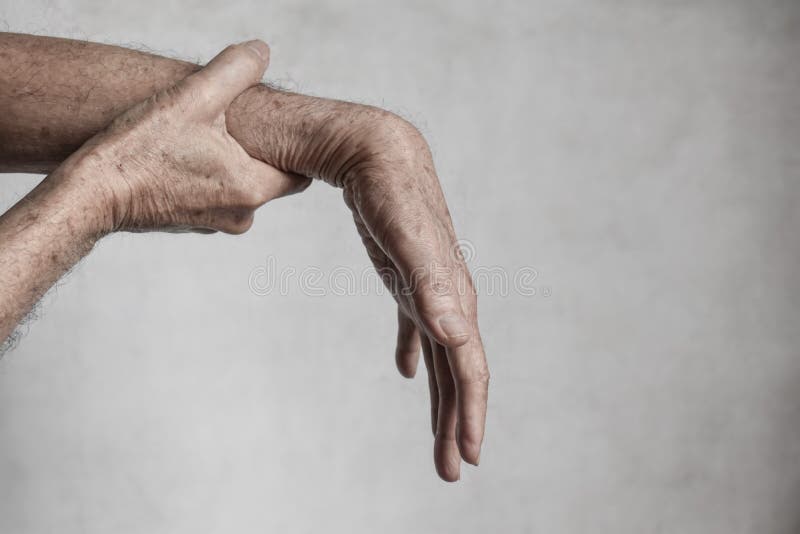 Radial Nerve Injury or Wrist Drop Stock Photo Image of fingers, elder