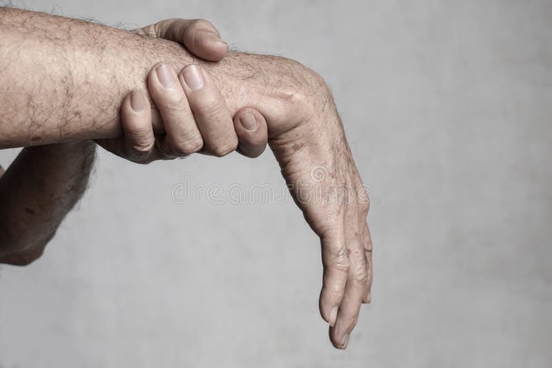 Radial Nerve Injury or Wrist Drop Stock Photo Image of spasm, aged