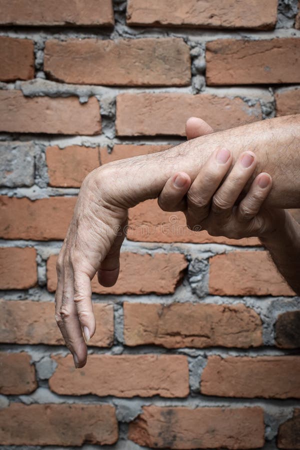 Radial Nerve Injury or Wrist Drop Stock Image Image of flex, fingers