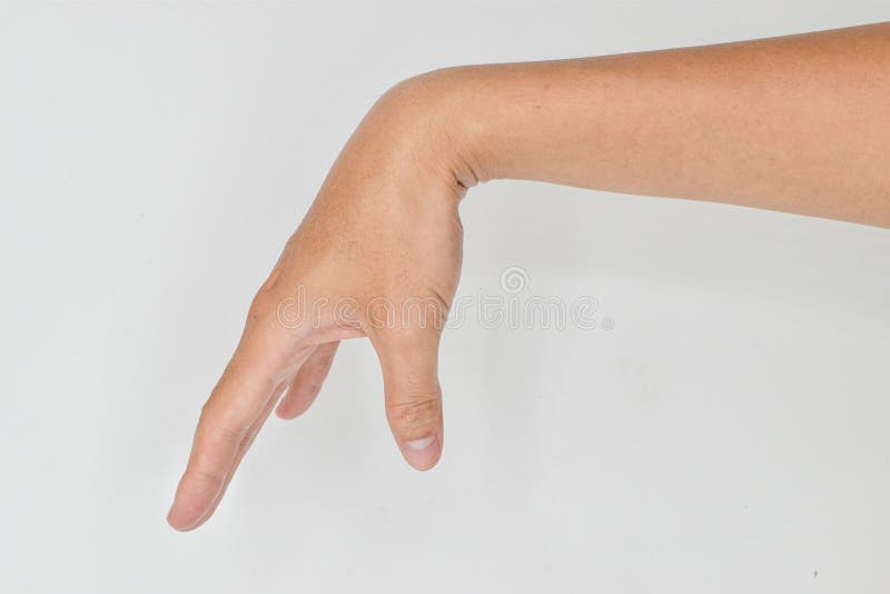 Radial Nerve Injury or Wrist Drop Stock Photo Image of isolated
