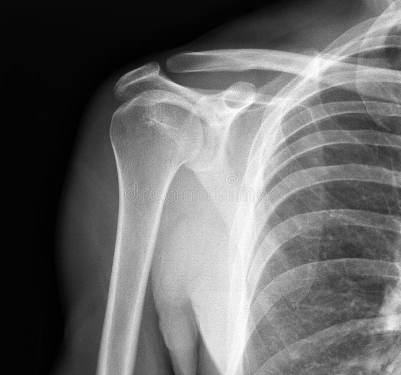 Imagen radiográfica de la junta de hombro