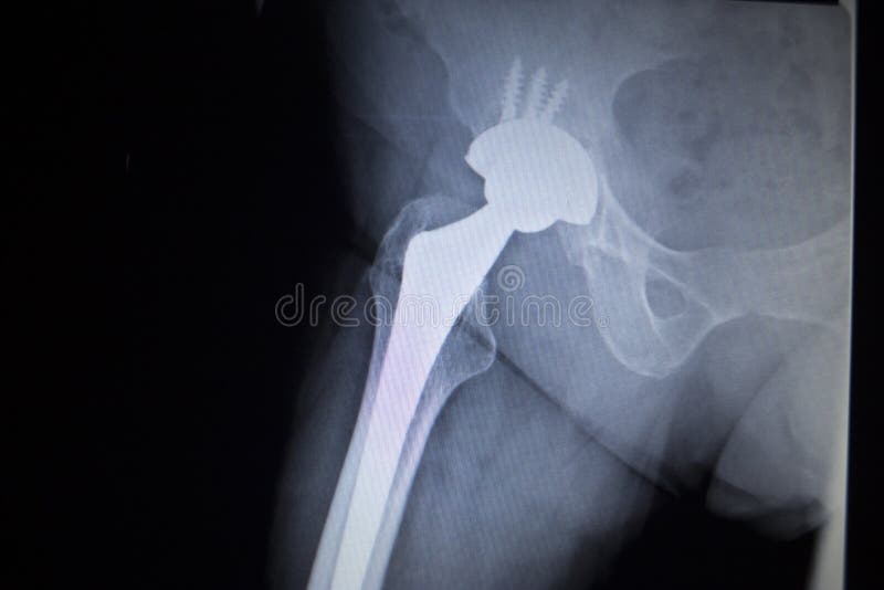 Radiografe a imagem da varredura do implante ortopédico da substituição da articulação da bacia imagens de stock royalty free Radiografe a imagem da varredura do implante ortopédico da substituição da articulação da bacia imagens de stock royalty free