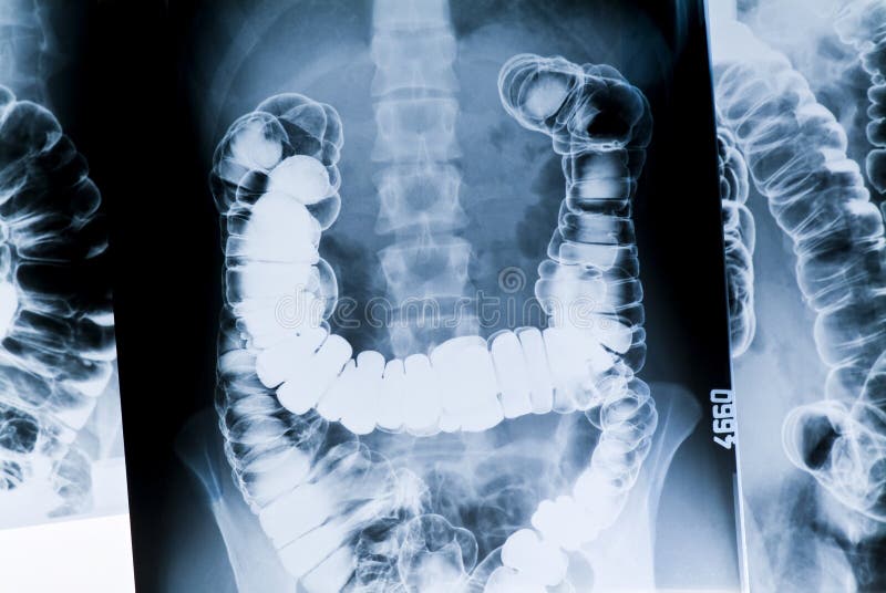 Bowel x-ray shows a large mass inside. Bowel x-ray shows a large mass inside