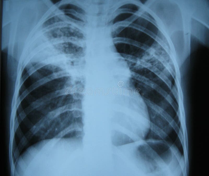 X-ray diagnostics of lung diseases/tuberculosis. X-ray diagnostics of lung diseases/tuberculosis