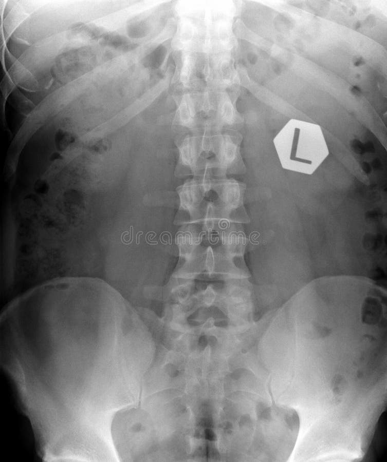 Radiografía de la espina dorsal. foto de archivo Radiografía de la espina dorsal. foto de archivo