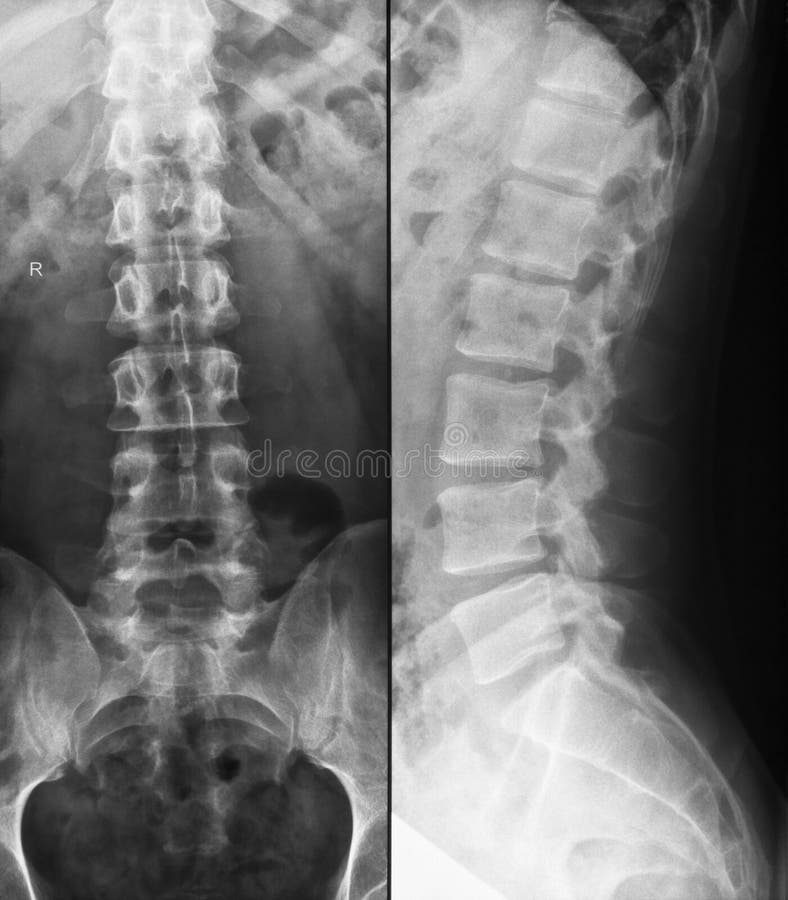 Radiografía de la espina dorsal lumbar con skoliosis s-shaped leve fotos de archivo libres de regalías Radiografía de la espina dorsal lumbar con skoliosis s-shaped leve fotos de archivo libres de regalías