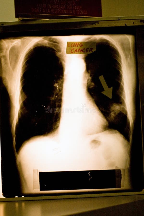 An x-ray of lung cancer with arrow pointing to the spot. An x-ray of lung cancer with arrow pointing to the spot.