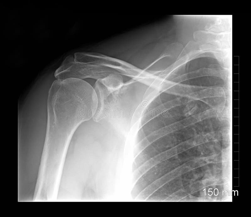 Shoulder xray isolated on a black background. Shoulder xray isolated on a black background