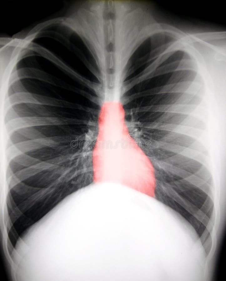 Black and white X-ray of the chest, showing the heart highligted in red. Black and white X-ray of the chest, showing the heart highligted in red.