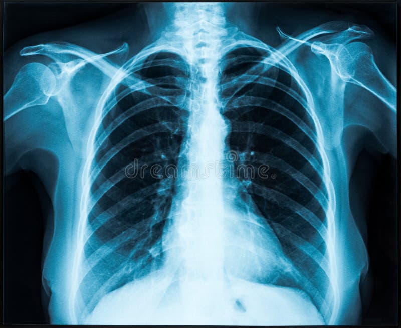 Woman thorax x-ray for lungs examination. Woman thorax x-ray for lungs examination