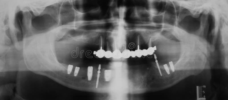 Radiografía dental imágenes de archivo libres de regalías Radiografía dental imágenes de archivo libres de regalías