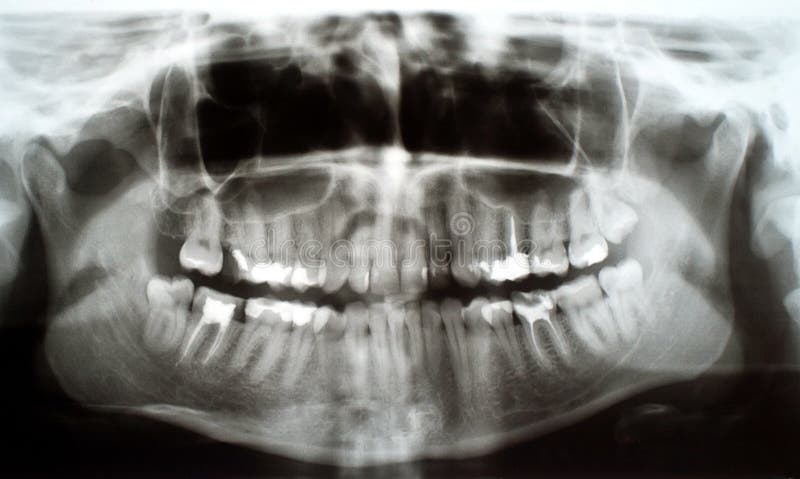 Radiografía dental foto de archivo libre de regalías Radiografía dental foto de archivo libre de regalías