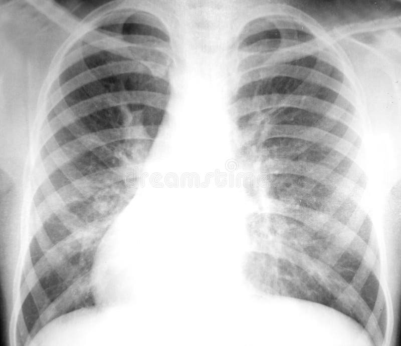 Radiographie de la poitrine image stock Radiographie de la poitrine image stock