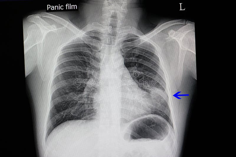 Radiographie De La Poitrine D Un Patient Presentant La Pneumonie Photo Stock Image Du Fond Clavicule