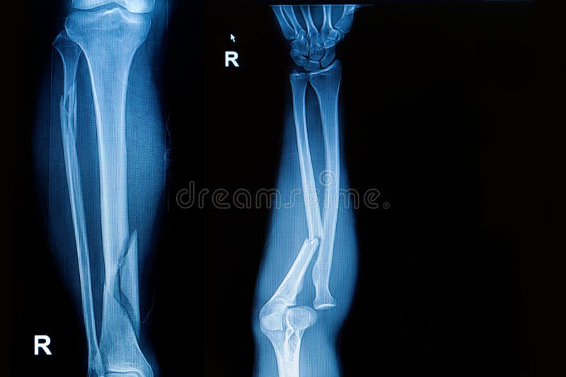 Radiologiczna wizerunku przedstawienia przełamu noga i przedramię. Radiologiczna wizerunku przedstawienia przełamu kość noga i przełamu dyszel ulnar przedramię