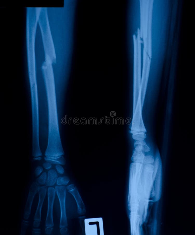 Radiologiczny film fotografia royalty free